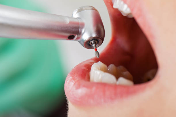 Best Emergency Wisdom Teeth Removal in Red Springs, NC